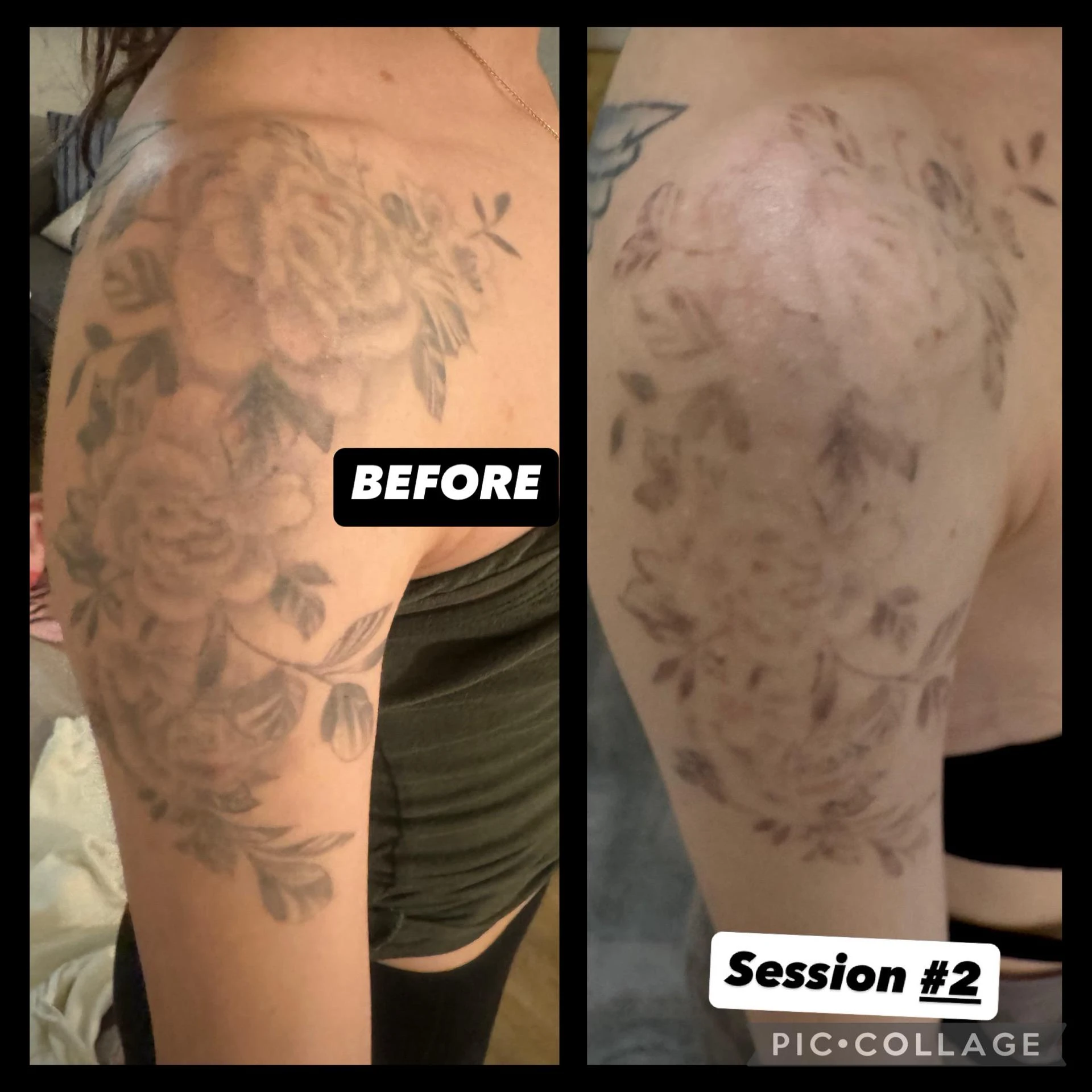 black tattoo before laser removal