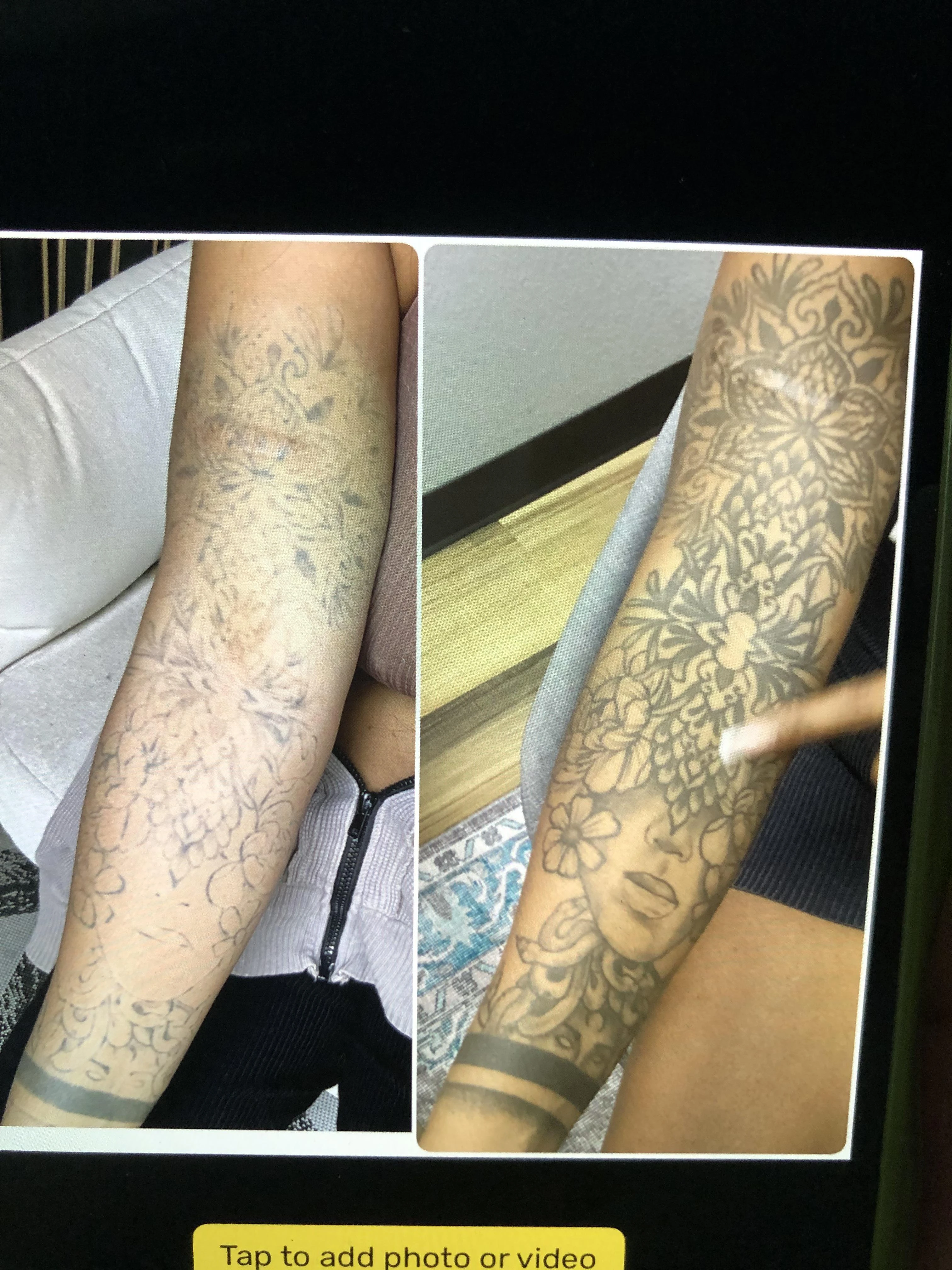 black tattoo before laser removal