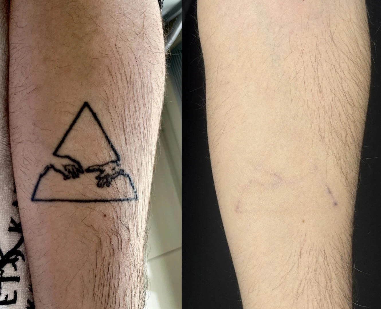 black tattoo before laser removal