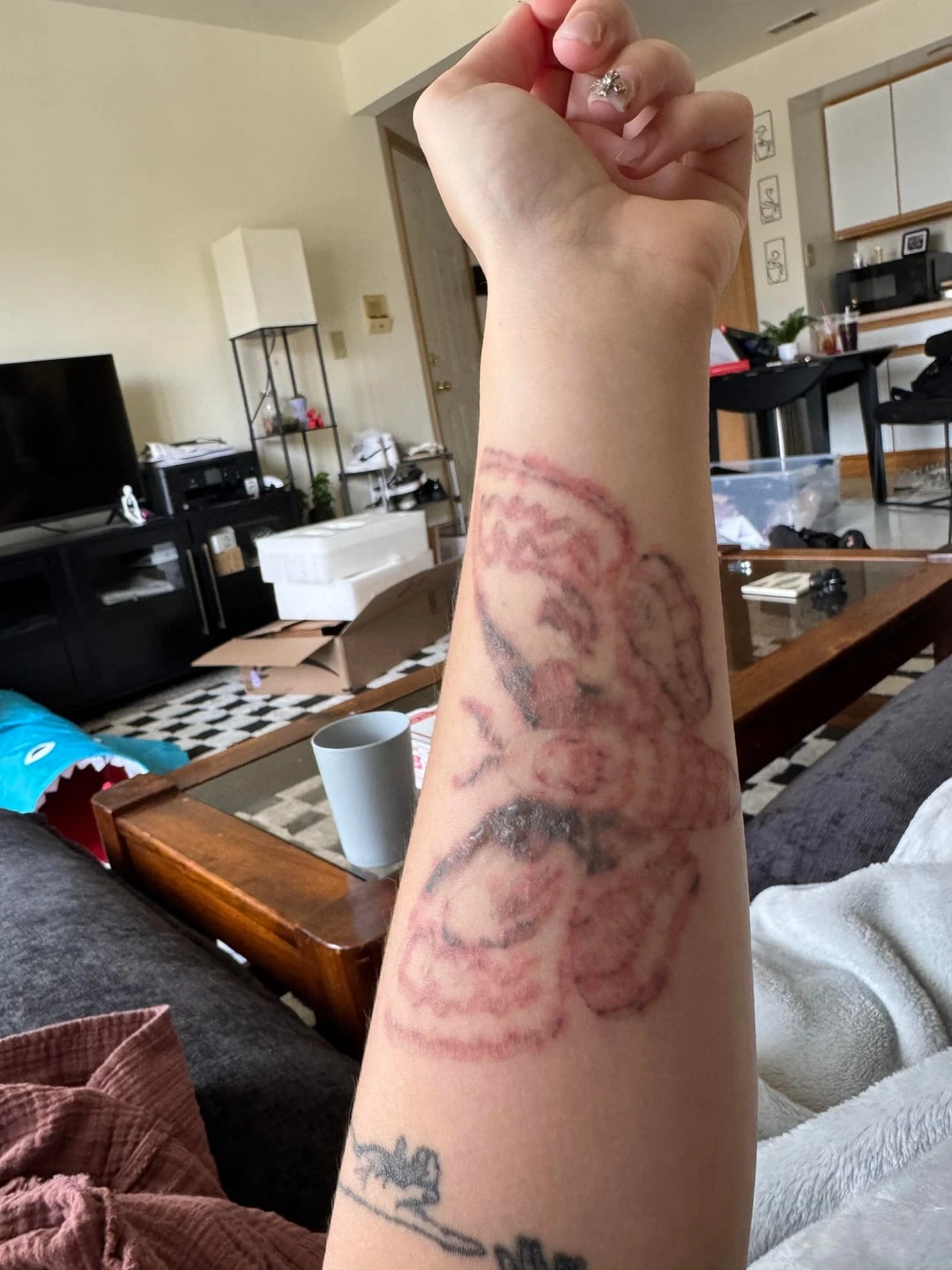 black tattoo before laser removal