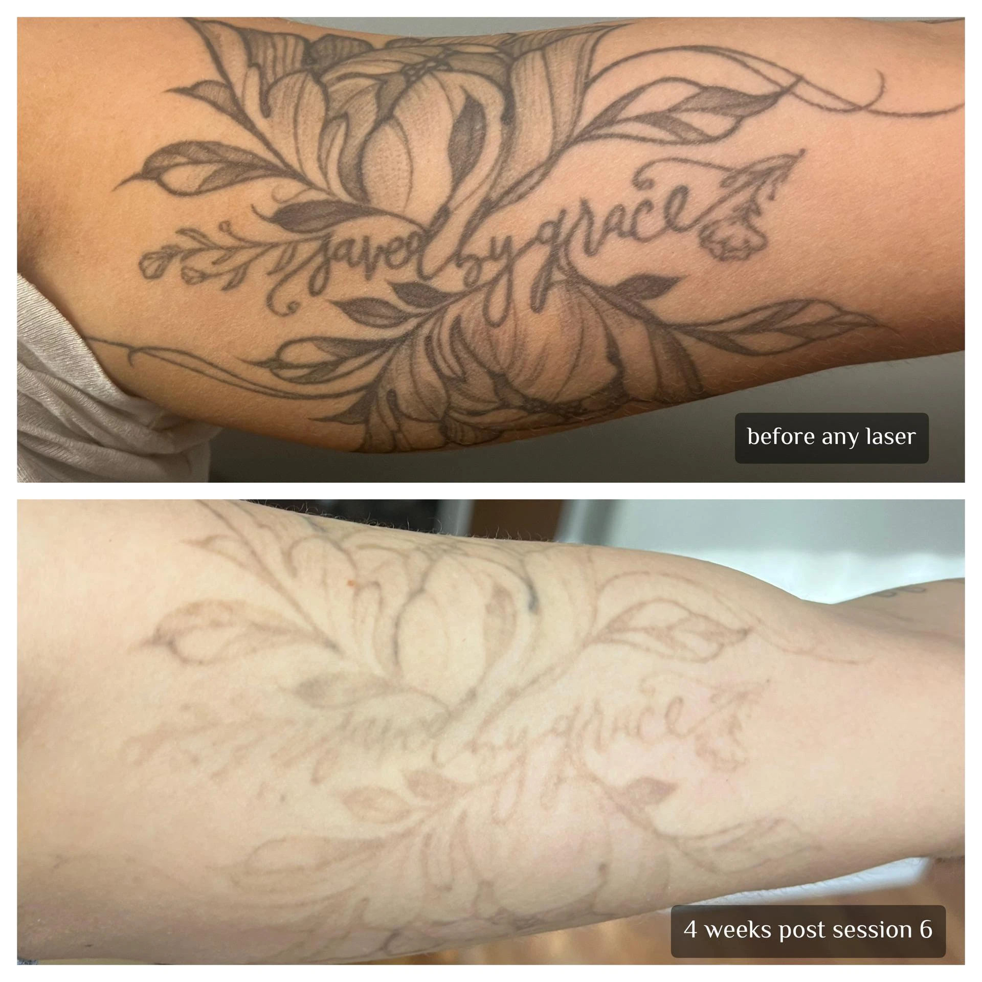 black tattoo before laser removal