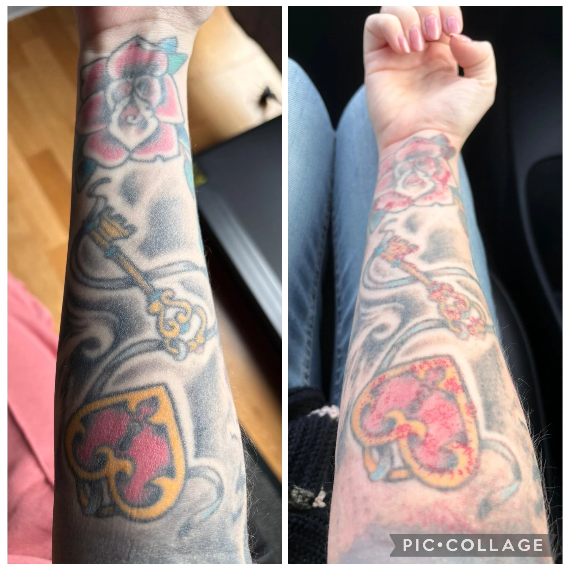 black tattoo before laser removal