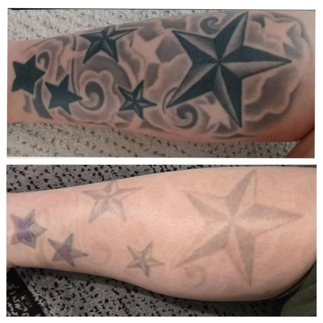 black tattoo before laser removal