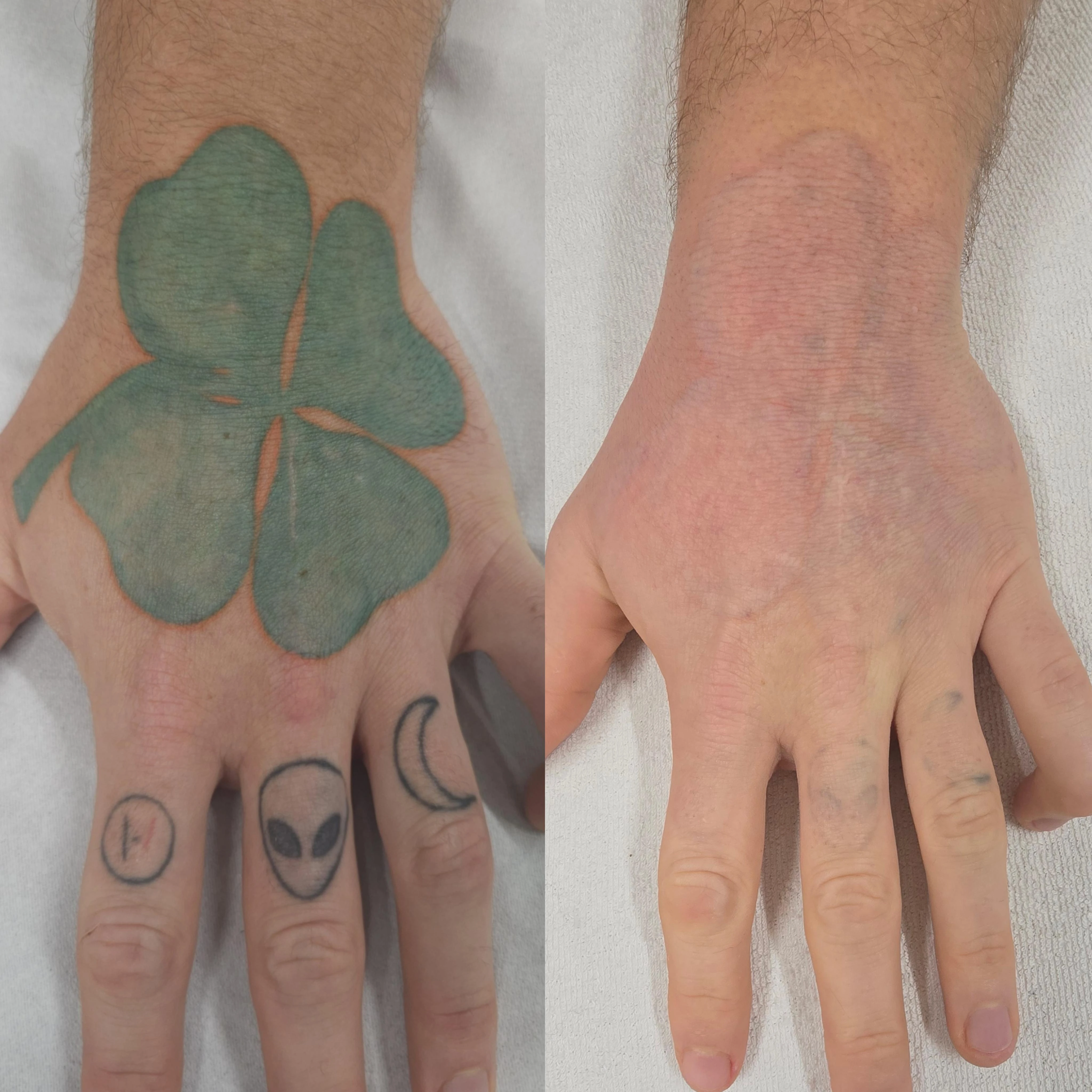 green and yellow tattoo before laser removal