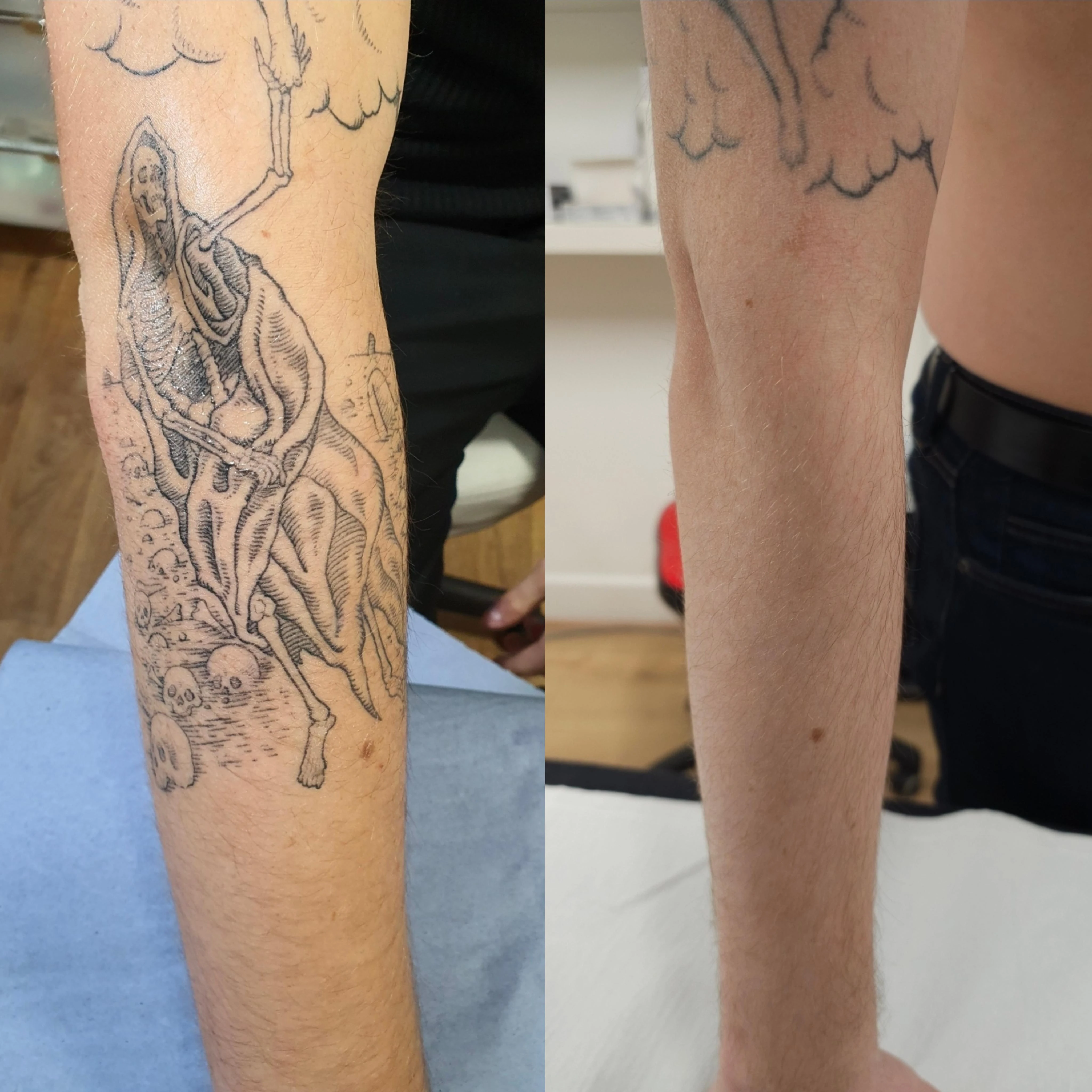 black tattoo before laser removal