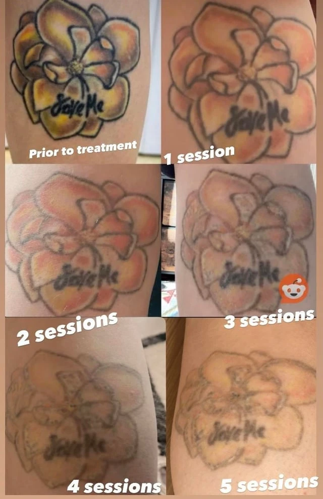 white tattoo after 6 sessions