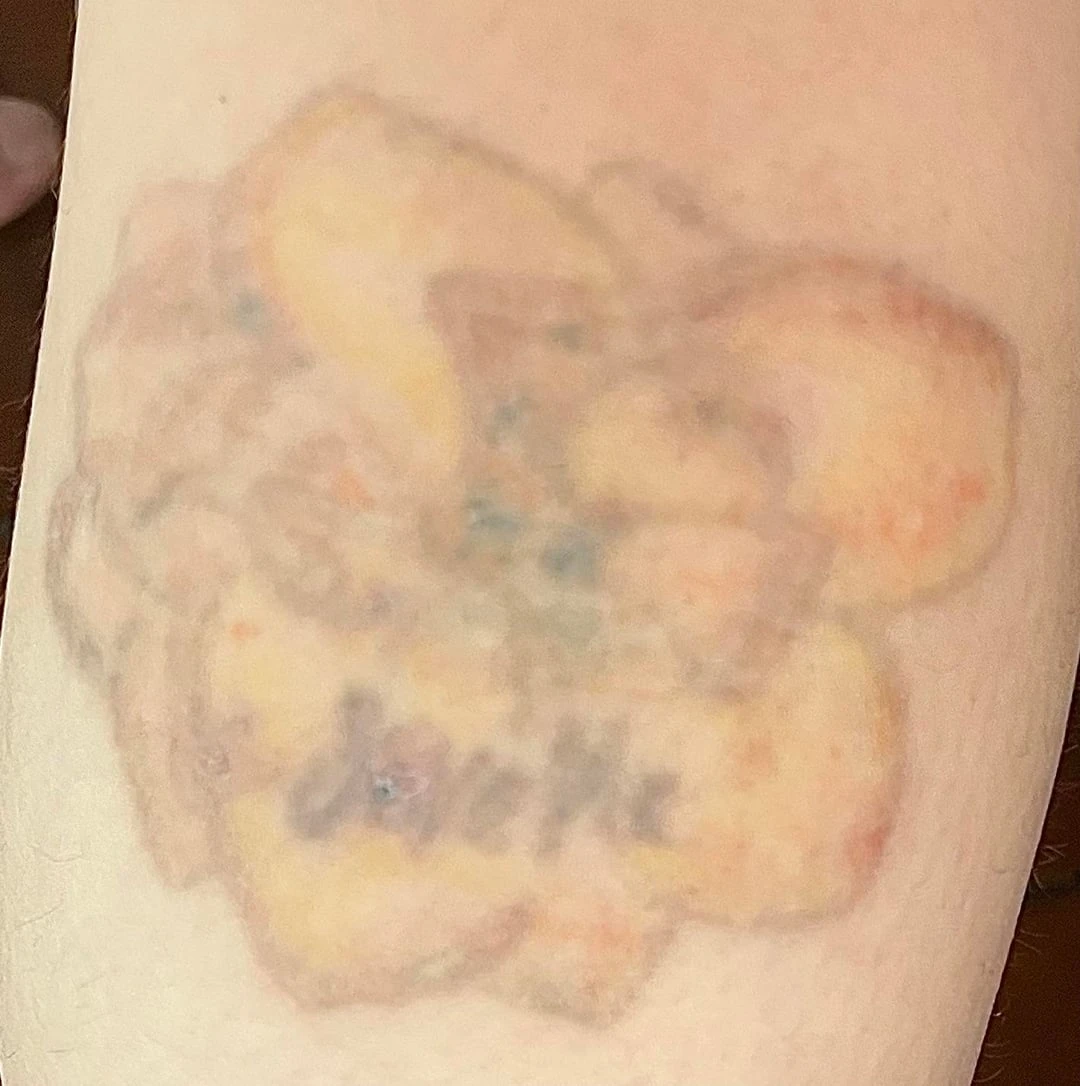 white tattoo before laser removal