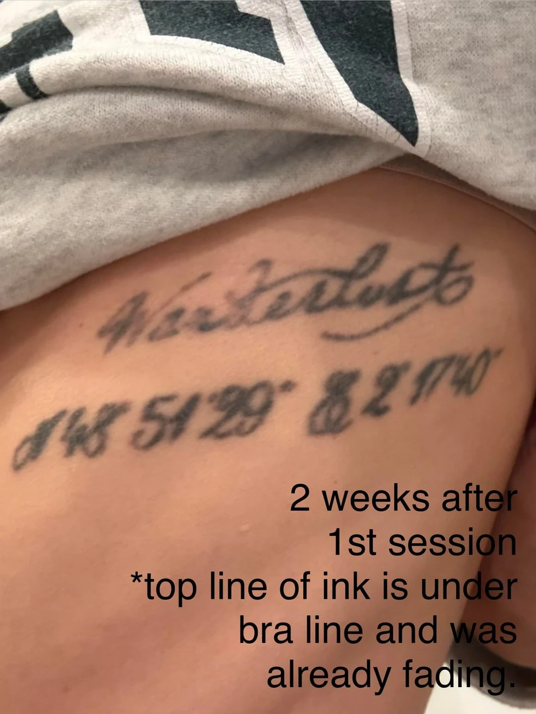 black tattoo before laser removal