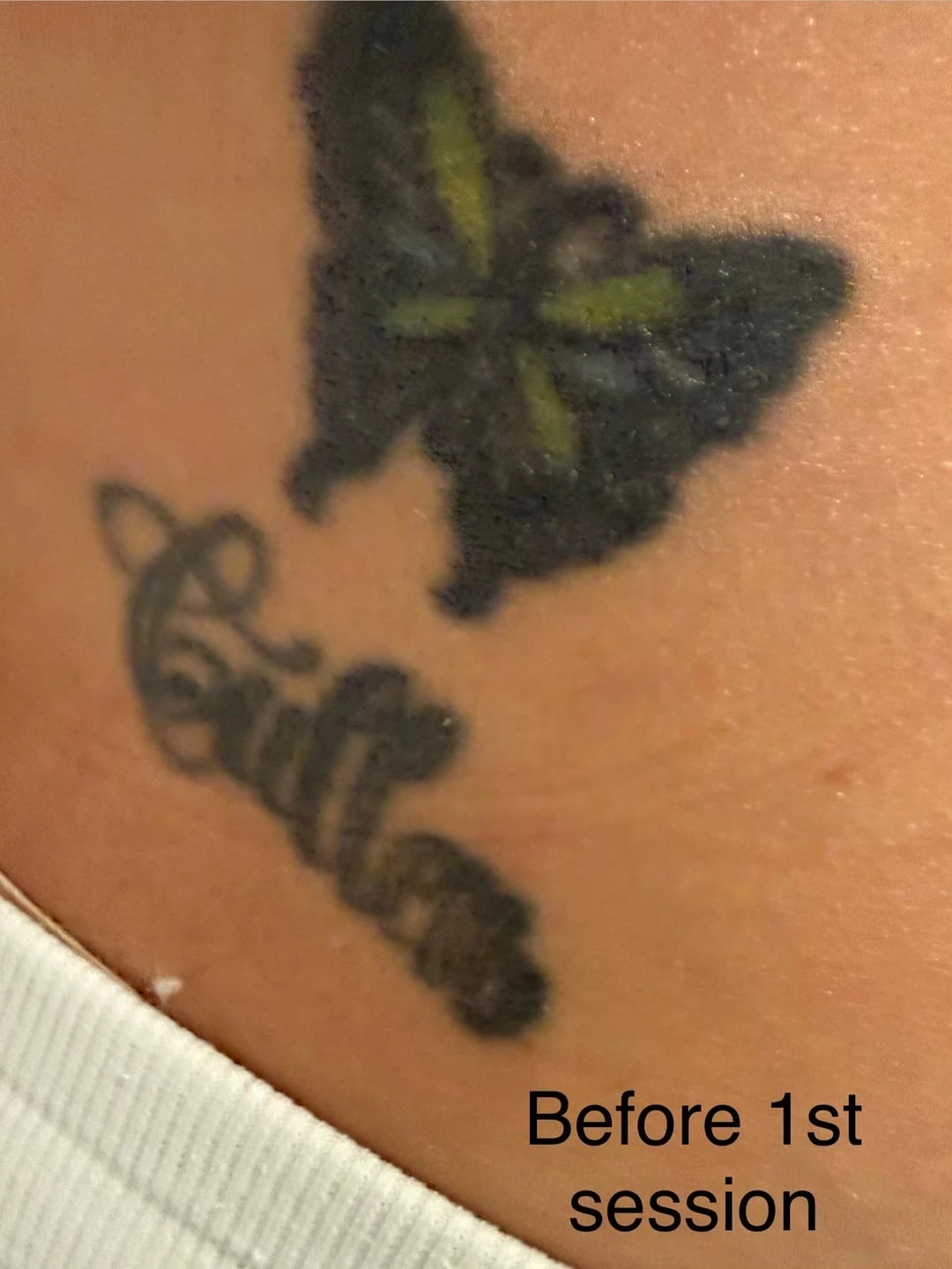 black tattoo after 1 sessions
