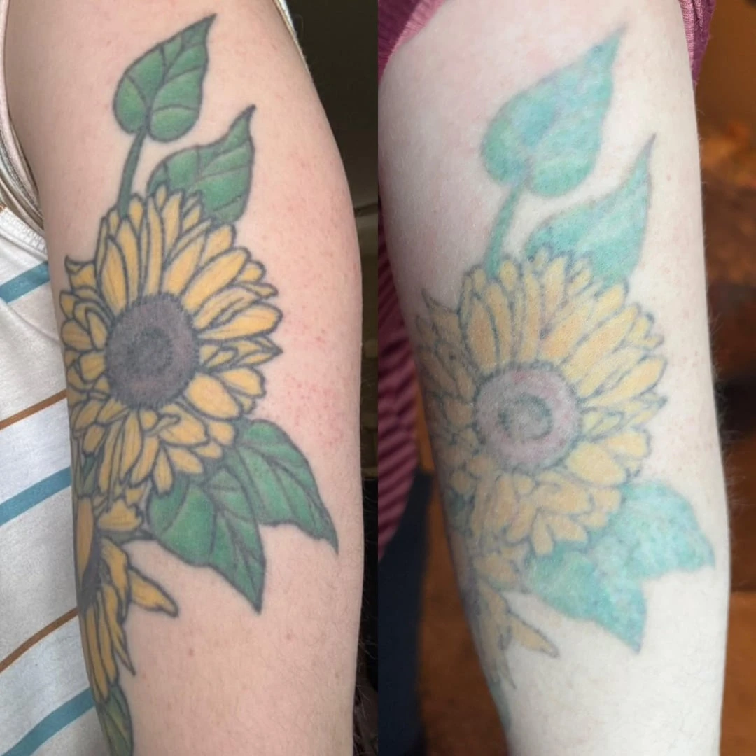 green tattoo before laser removal