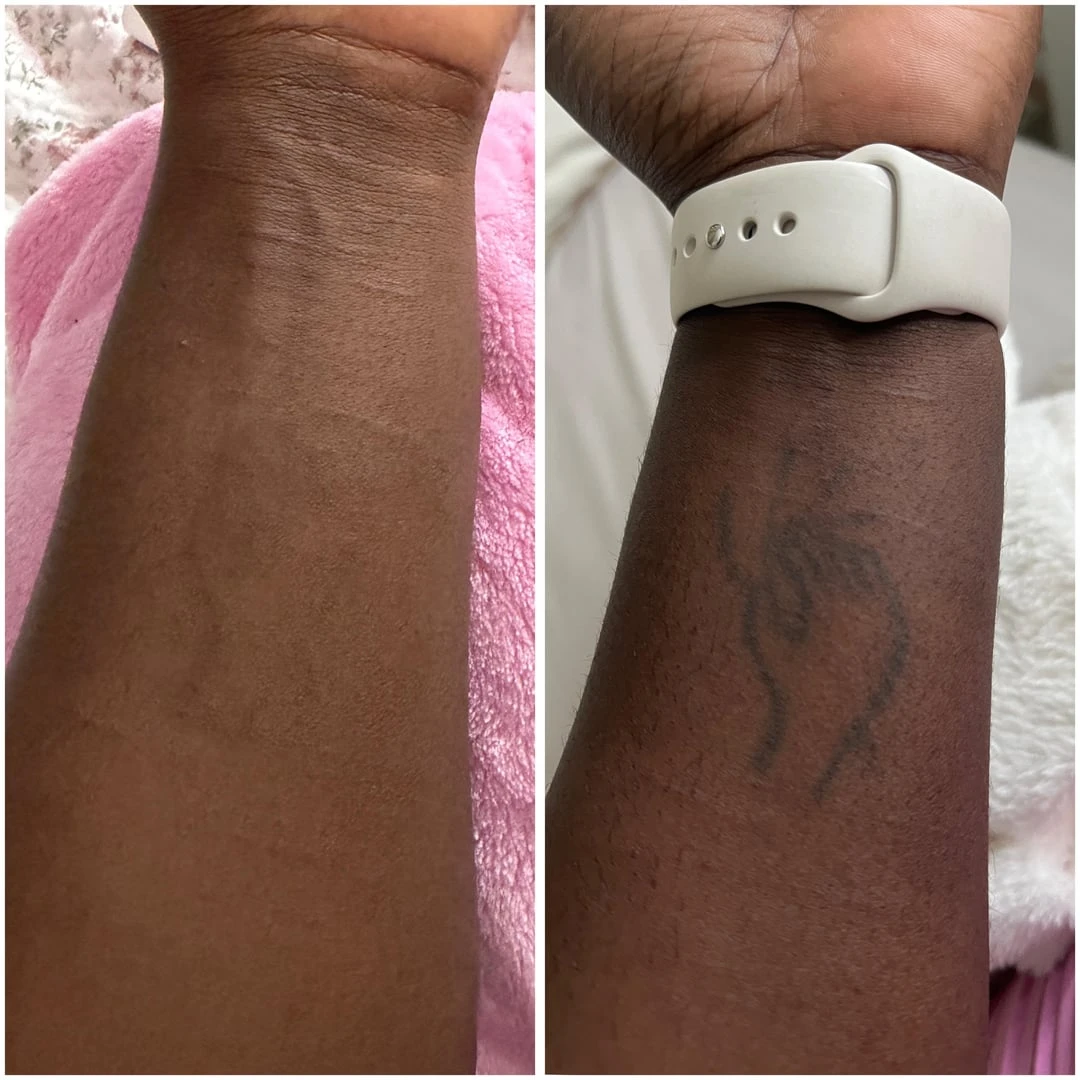 white tattoo before laser removal