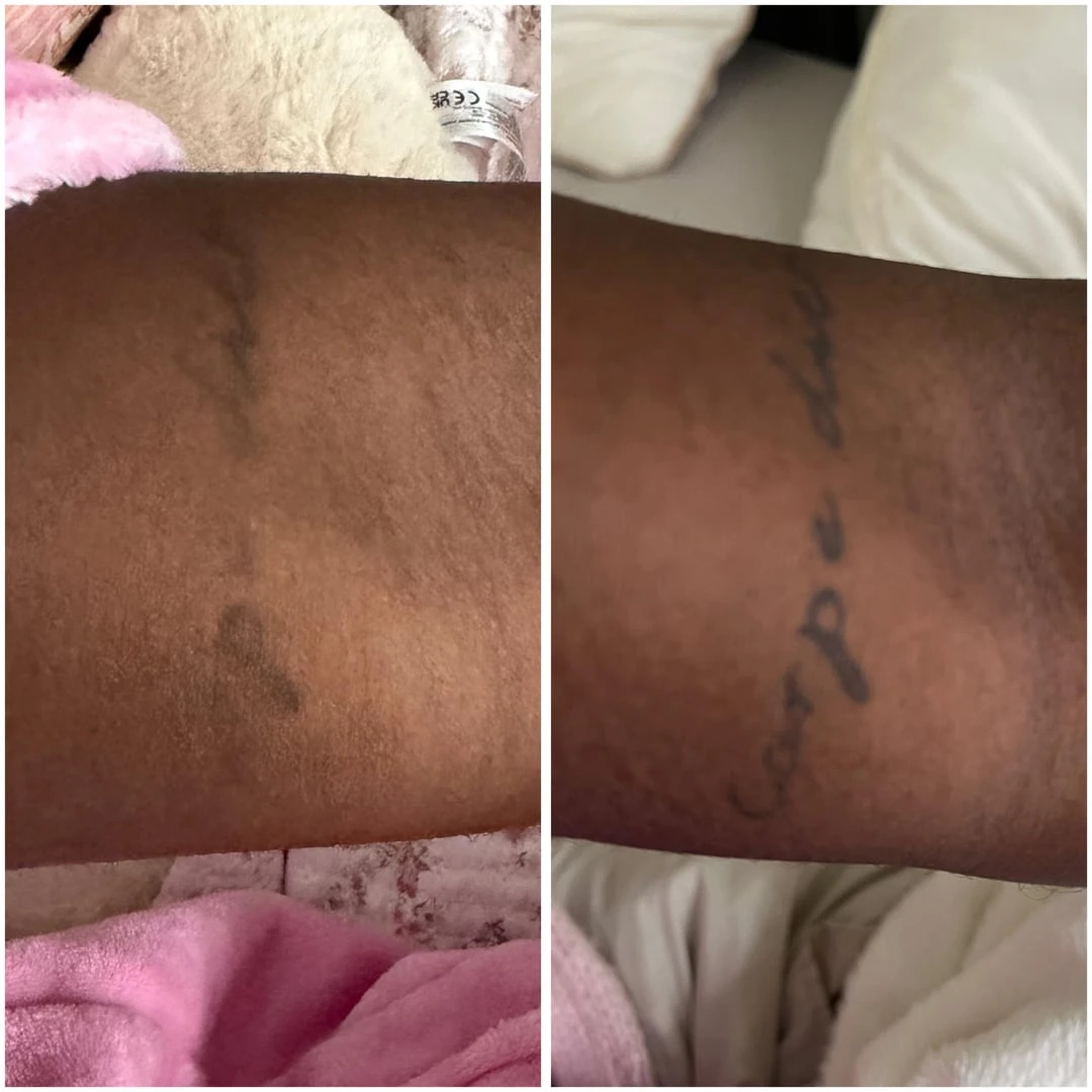 white tattoo after  sessions
