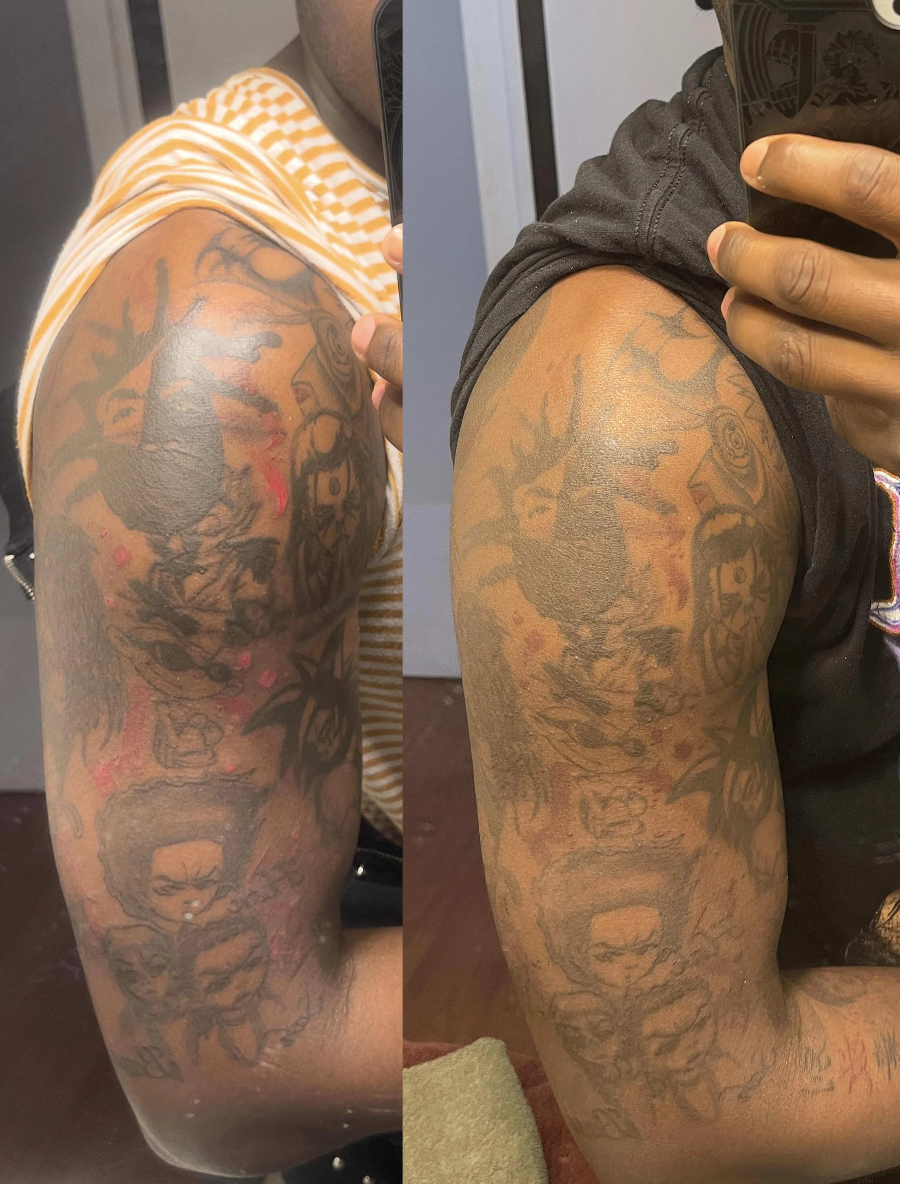 black tattoo before laser removal