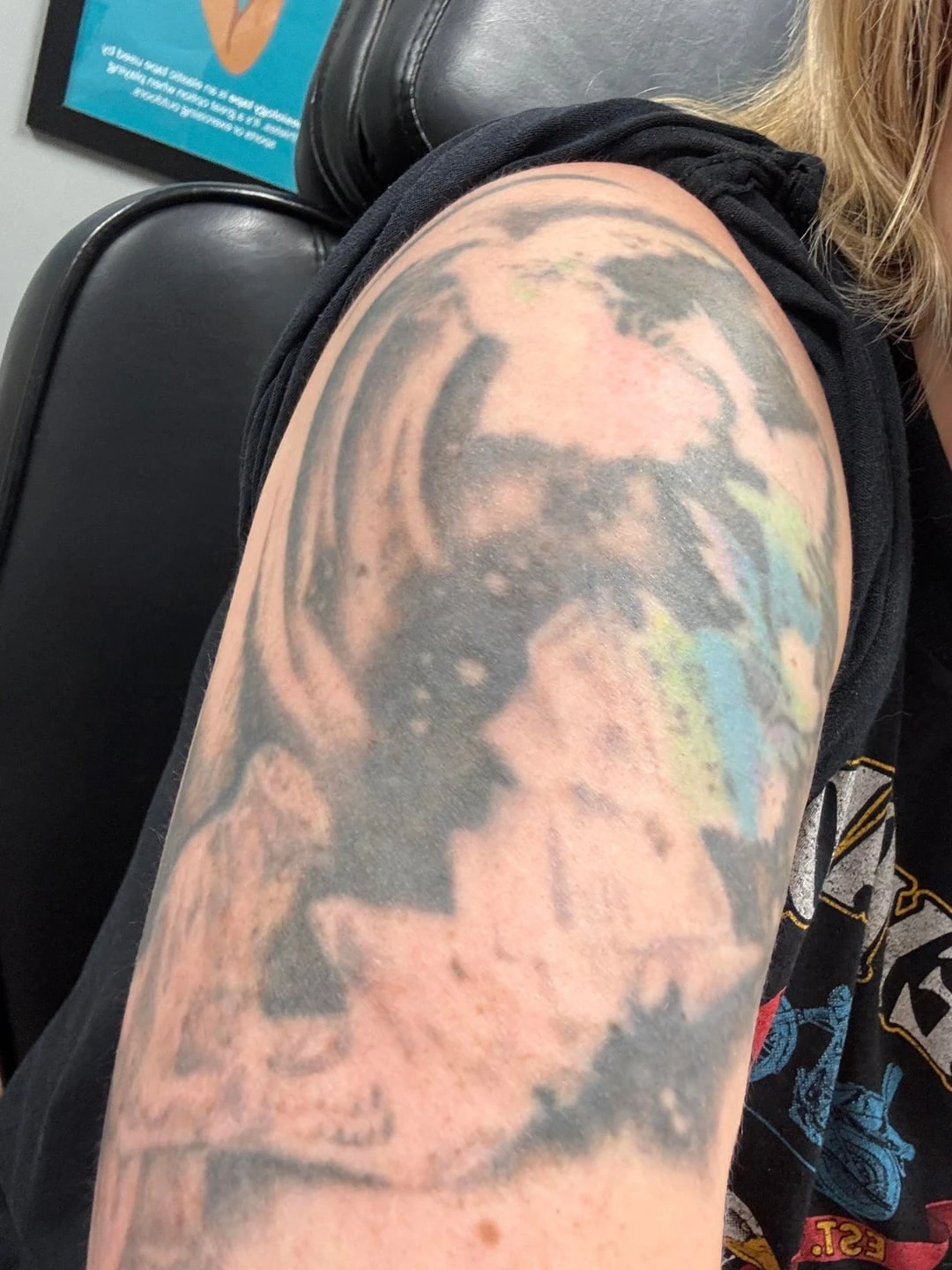 Multicolor tattoo session 2 laser tattoo removal