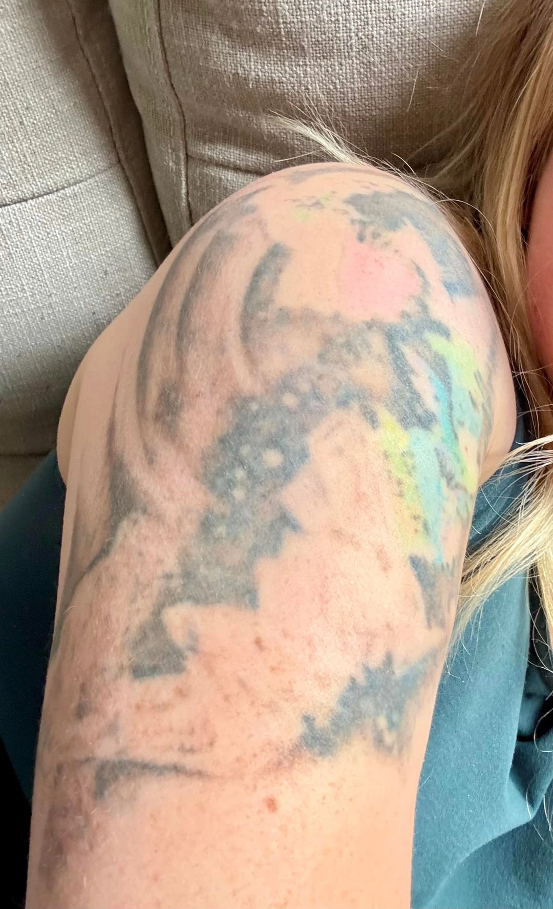 Multicolor tattoo session 3 laser tattoo removal