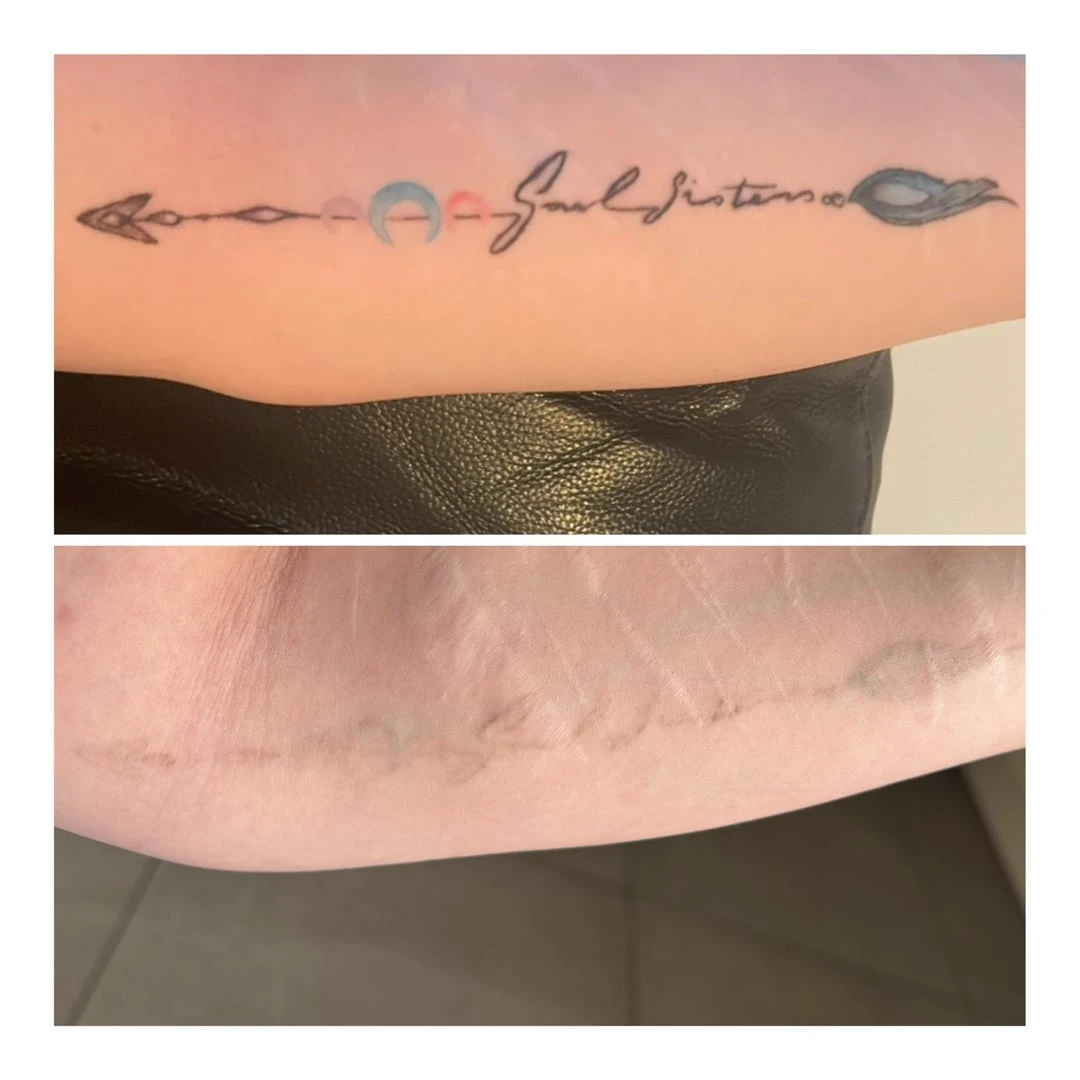 black tattoo fading after 1 session of laser removal with Candela Picoway