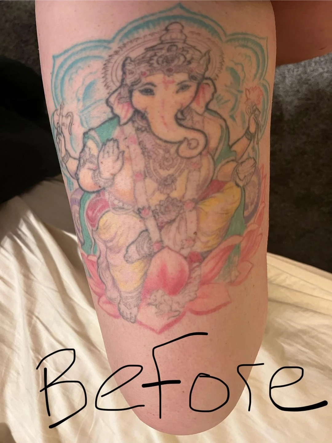 white tattoo before laser removal