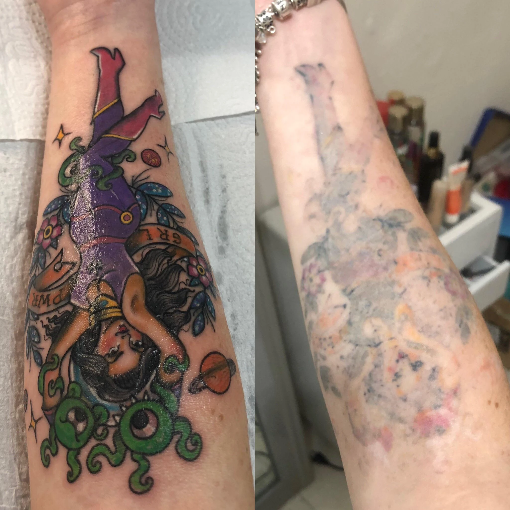Multicolor tattoo session 5 laser tattoo removal