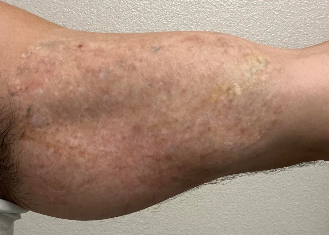After complete removal tattoo removal