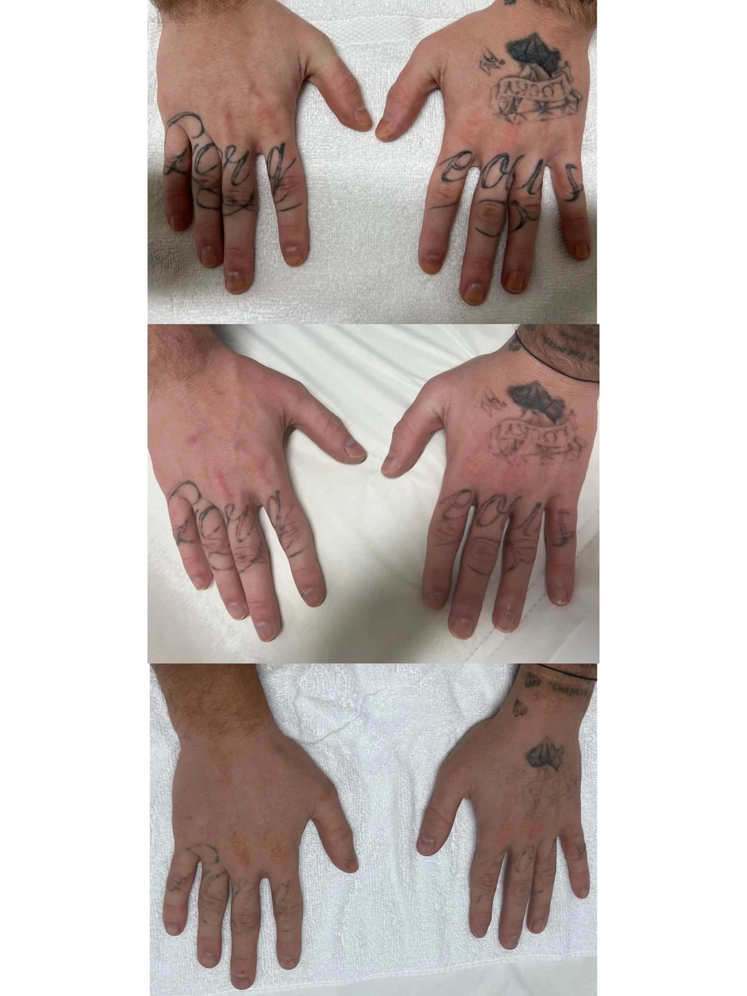 black tattoo after 2 sessions