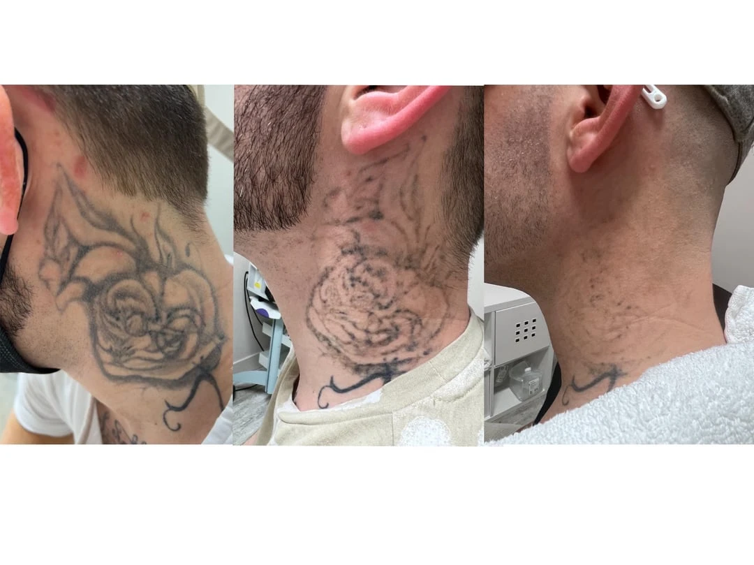 black tattoo before laser removal