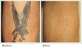 Berman Skin Institute in Pleasanton CA before and after result 1