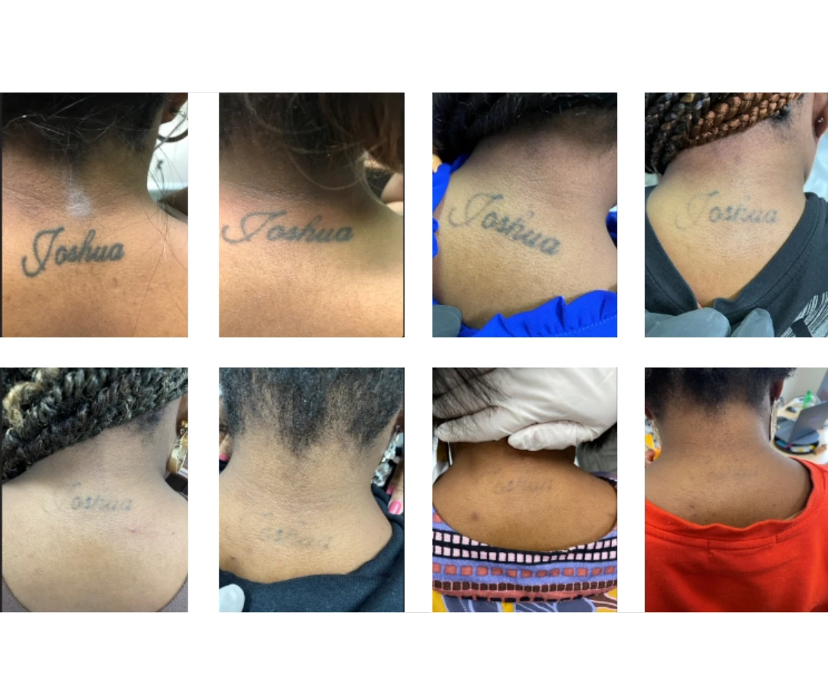 Shipers Laser Tattoo Removal Center Dallas before and after result 1