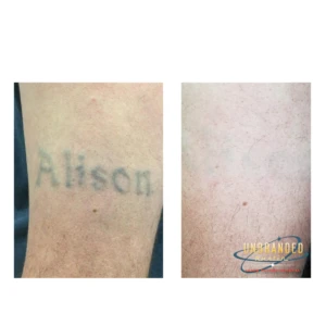 UNBRANDED Austin before and after result 1