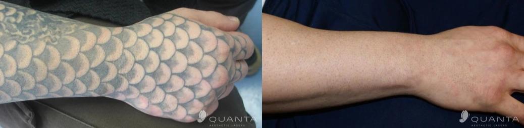 Revolution Ink Studio before and after result 1