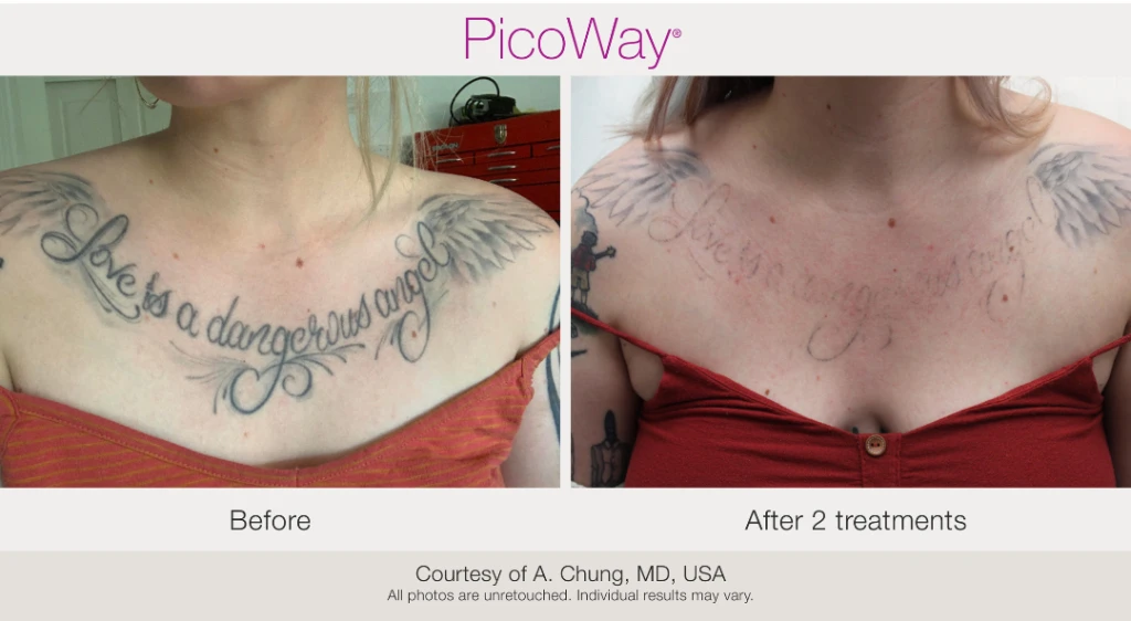 Erase & Embrace Tattoo Removal before and after result 1