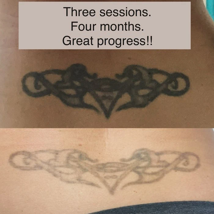 Kailua Laser Tattoo Removal before and after result 1