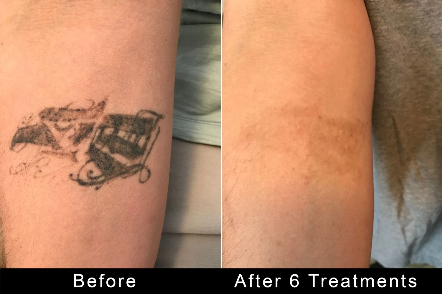 TattooRemovers.ink before and after result 1