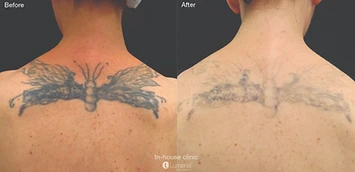 NU Med Spa before and after result 1