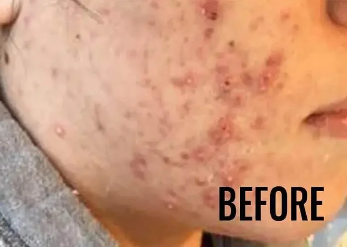 Beautybar424 before and after result 1