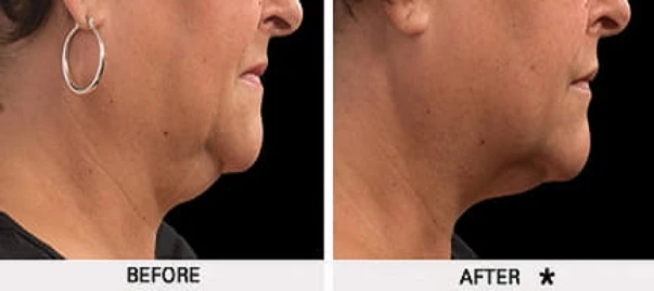 Rejuvenation Center before and after result 1
