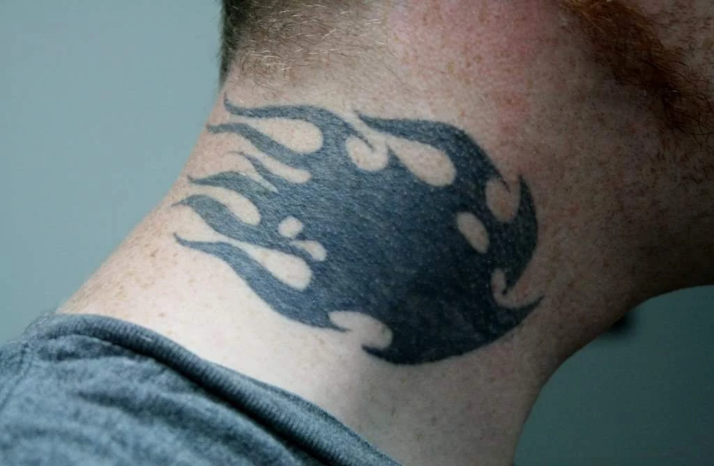 Under My Skin Tattoo Removal before and after result 1